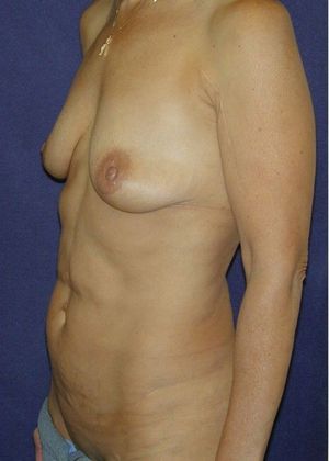 Before Image: Mommy Makeover: Case 9 - left-front-oblique