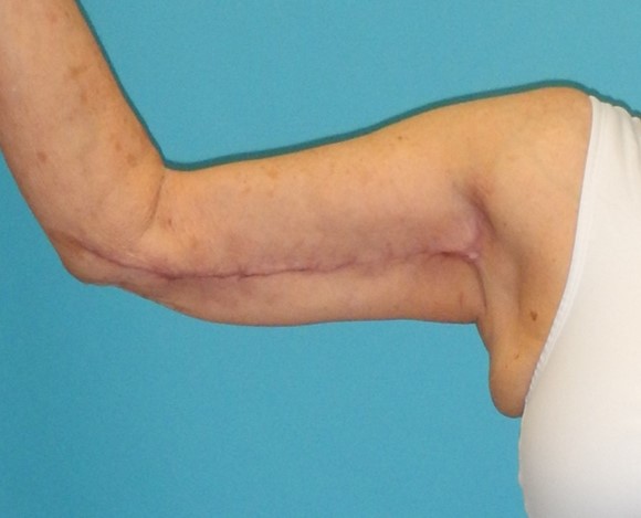 After Image: Arm Lift: Case 5 - front