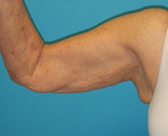 Before Image: Arm Lift: Case 5 - front