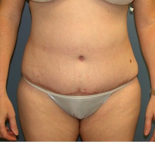 After Image: Body Lift: Case 11 - front