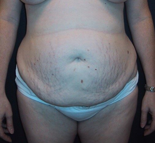 Before Image: Body Lift: Case 11 - front