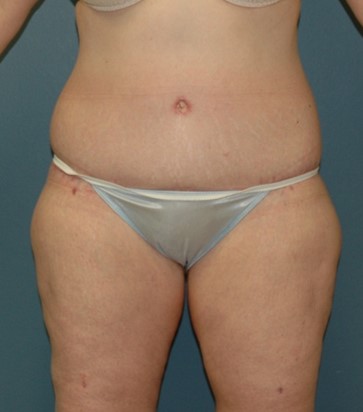 After Image: Body Lift: Case 10 - front