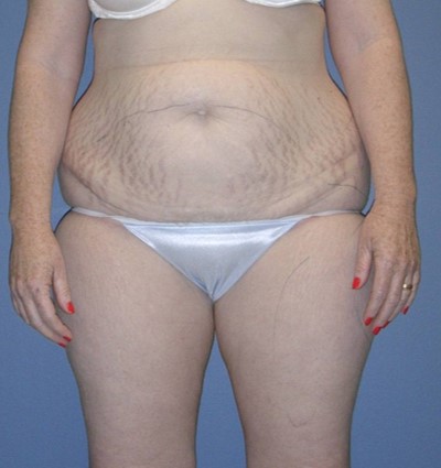 Before Image: Body Lift: Case 10 - front