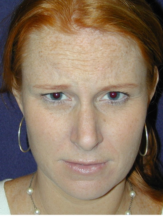 Before Image: Botox® Cosmetic: Case 2 - front