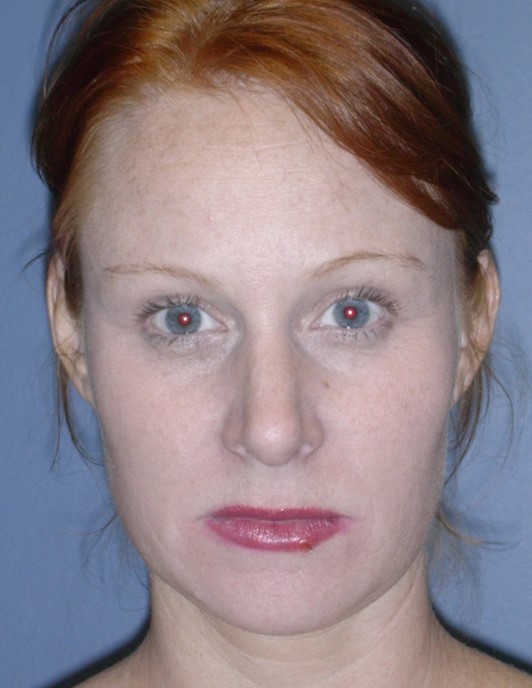After Image: Botox® Cosmetic: Case 2 - front