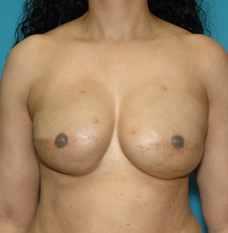 After Image: Breast Reconstruction: Case 14 - front