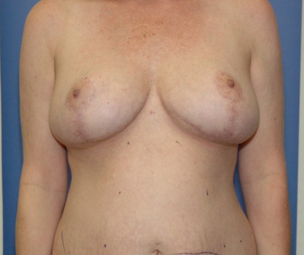 After Image: Breast Reduction: Case 9 - front
