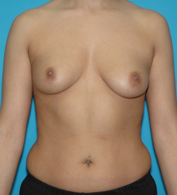 Before Image: Breast Augmentation: Case 31 - front