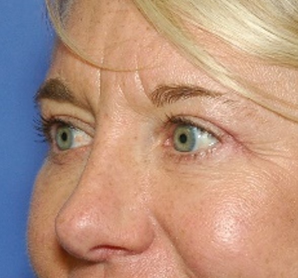 After Image: Eyelid Tuck: Case 2 - left-front-oblique