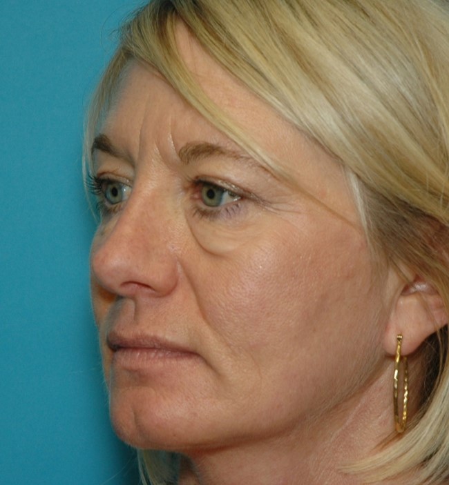 Before Image: Eyelid Tuck: Case 2 - left-front-oblique