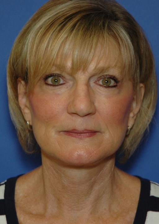 After Image: Facelift: Case 1 - front