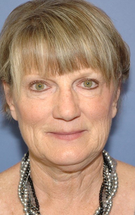 Before Image: Facelift: Case 1 - front