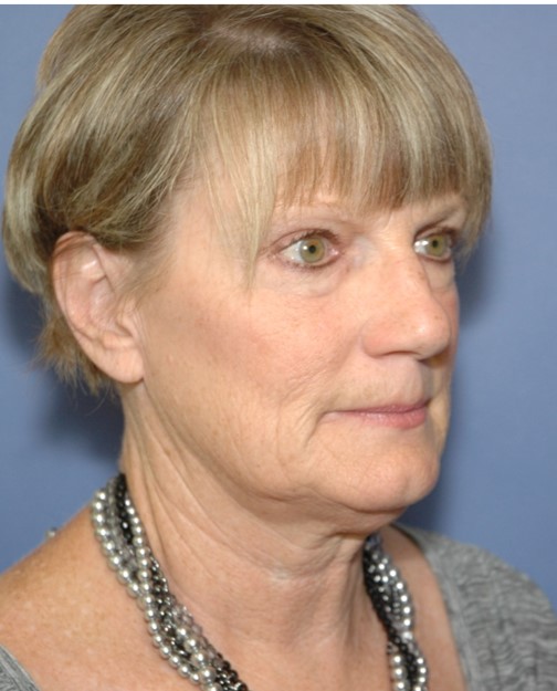 Before Image: Facelift: Case 1 - right-front-oblique