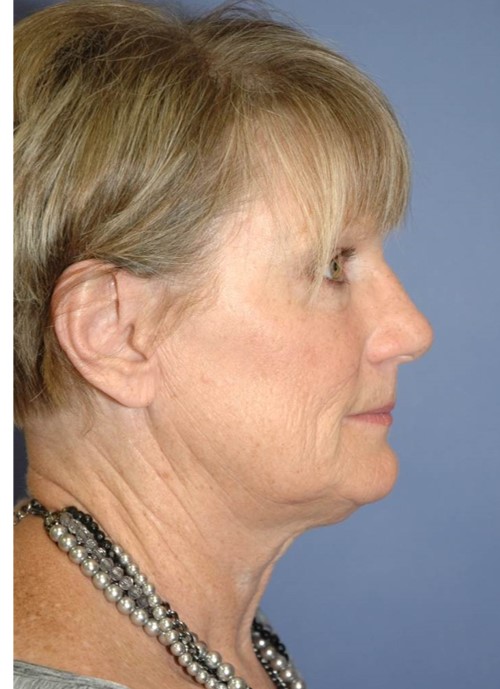 Before Image: Facelift: Case 1 -
