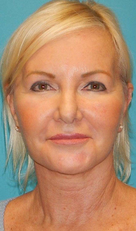 After Image: Facelift: Case 2 - front