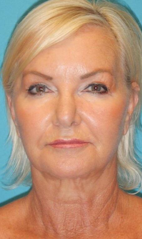 Before Image: Facelift: Case 2 - front