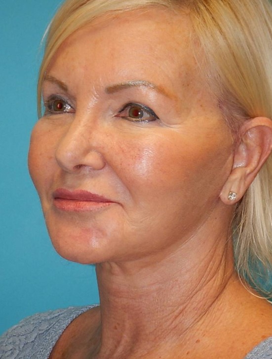 After Image: Facelift: Case 2 - left-front-oblique