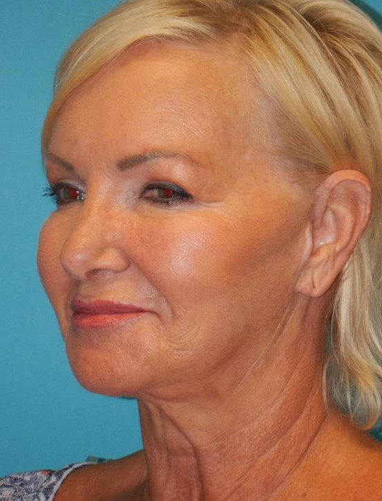 Before Image: Facelift: Case 2 - left-front-oblique