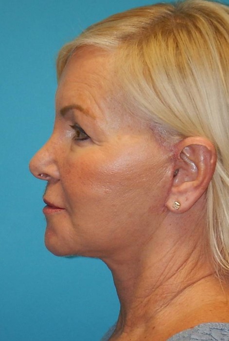 After Image: Facelift: Case 2 - left-side