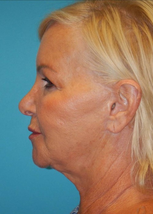 Before Image: Facelift: Case 2 - left-side