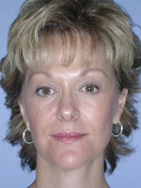 After Image: Fat Grafting Face: Case 8 - front