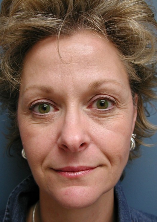 Before Image: Fat Grafting Face: Case 8 - front