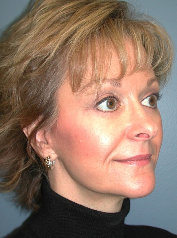 After Image: Fat Grafting Face: Case 8 - right-front-oblique