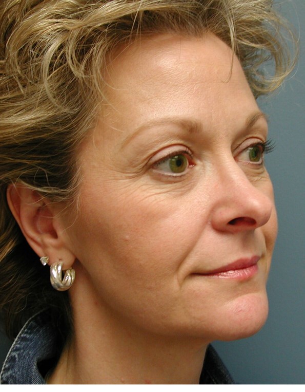 Before Image: Fat Grafting Face: Case 8 - right-front-oblique