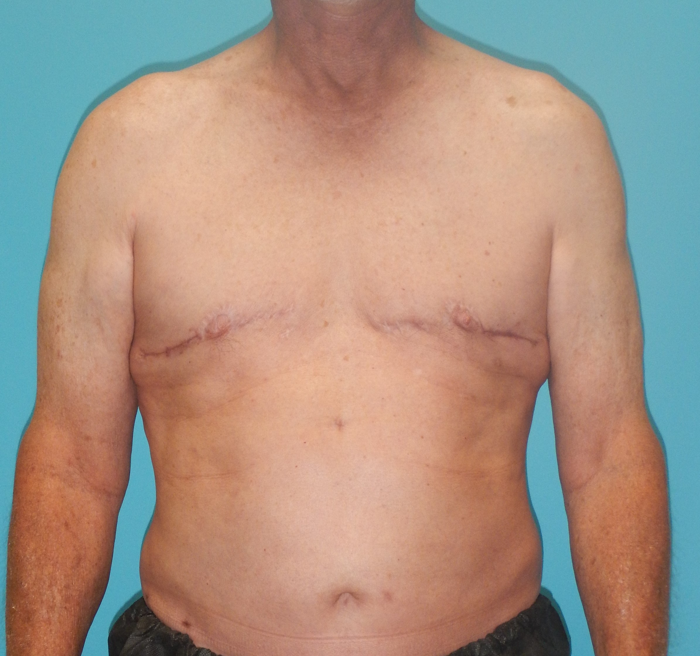 After Image: Gynecomastia: Case 5 - front
