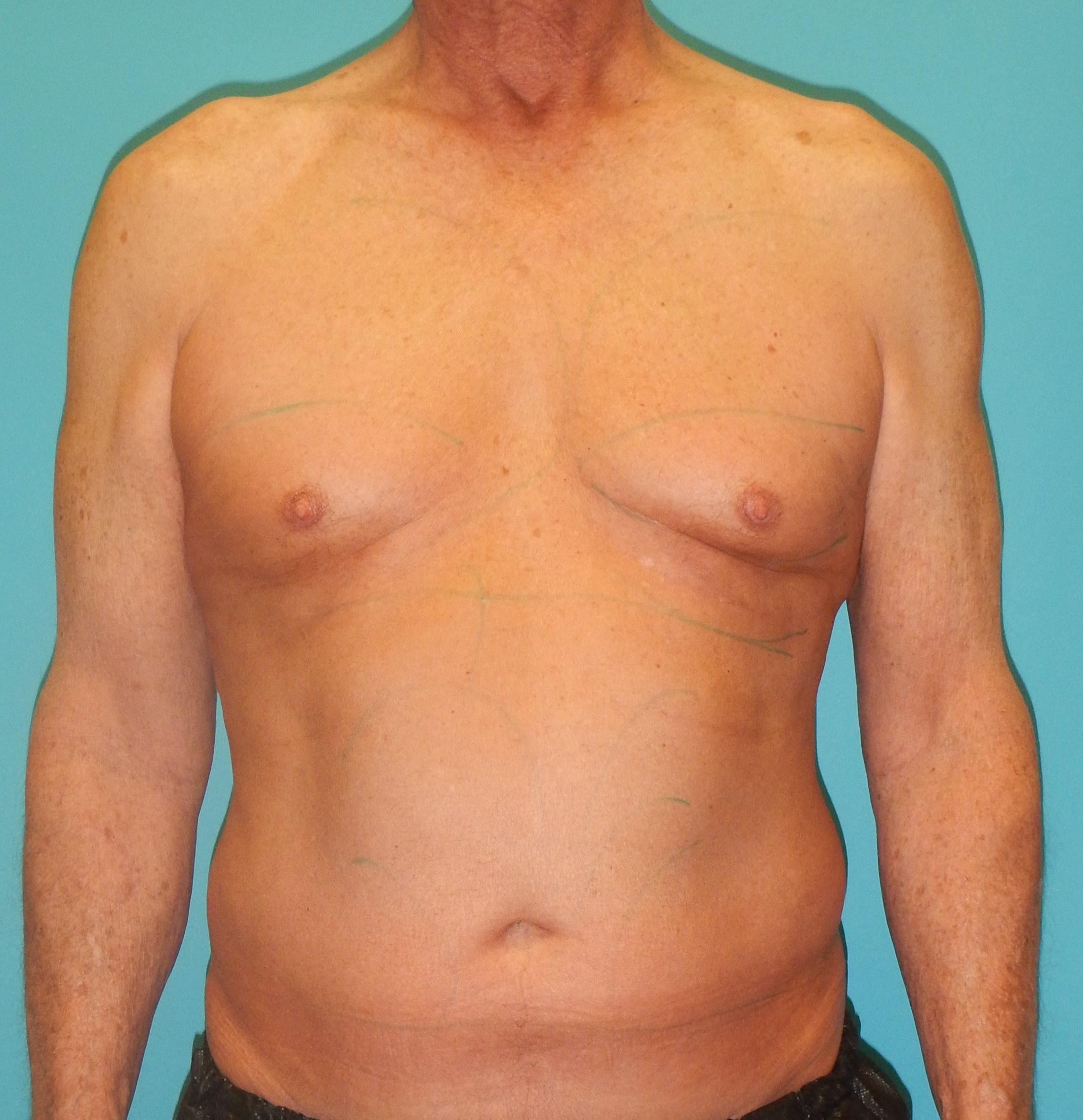 Before Image: Gynecomastia: Case 5 - front