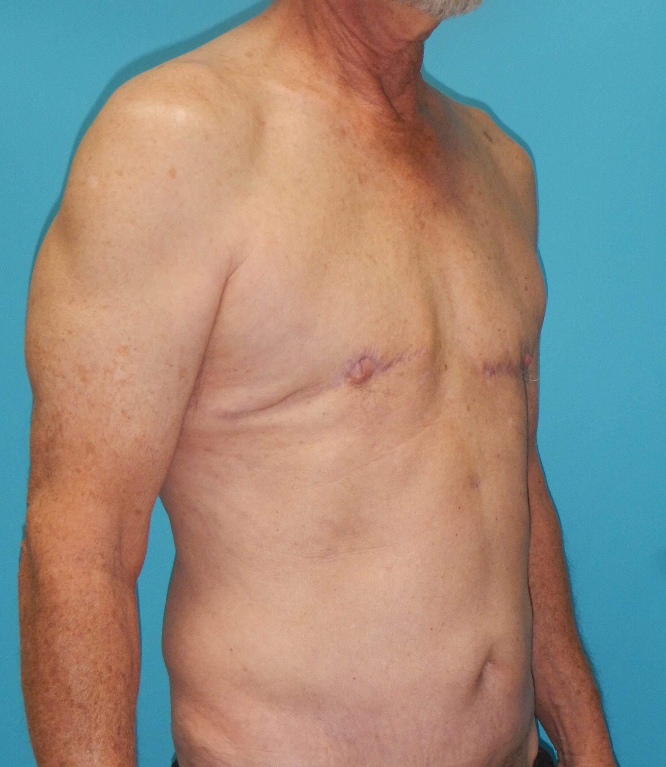 After Image: Gynecomastia: Case 5 - right-front-oblique