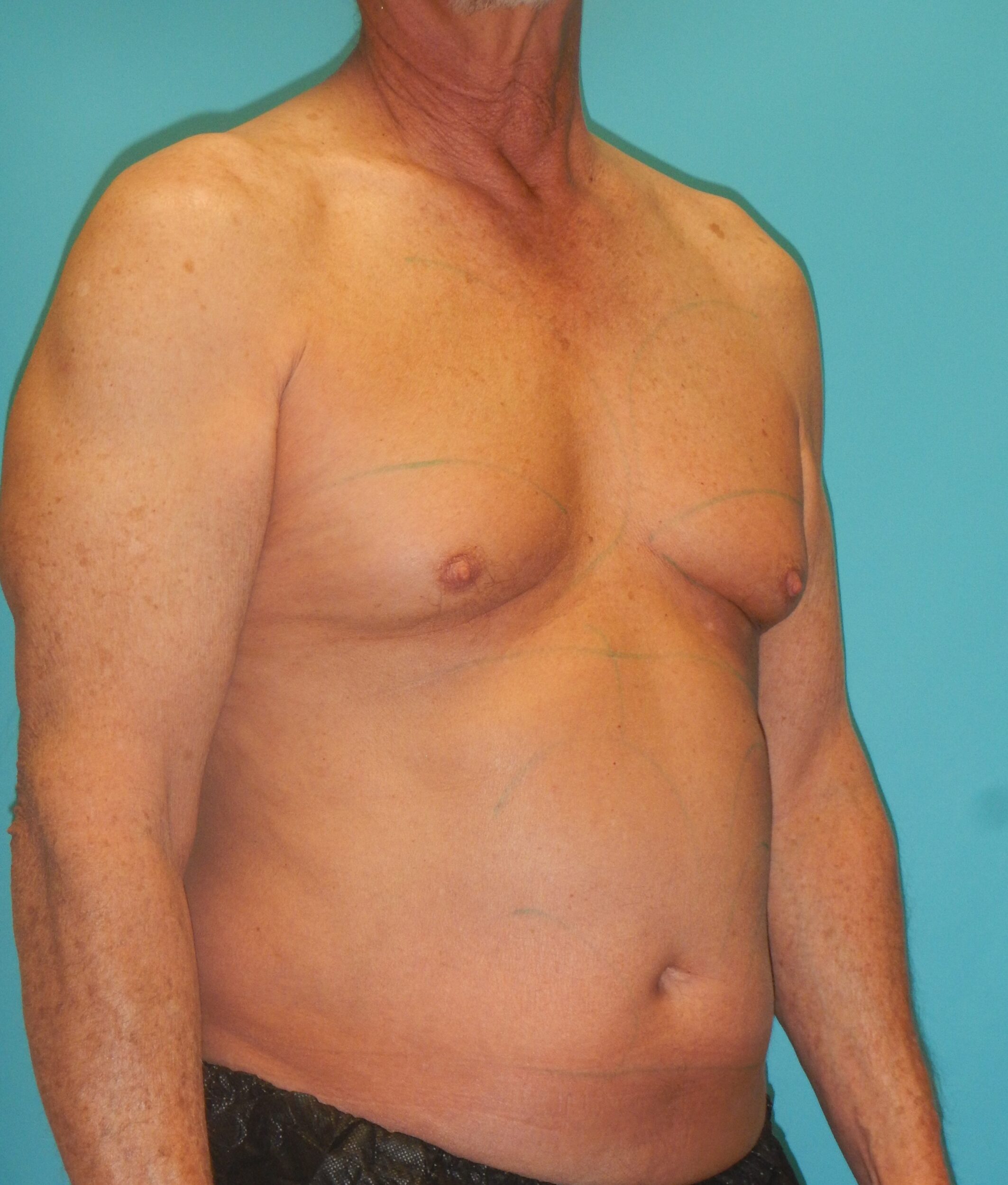 Before Image: Gynecomastia: Case 5 - right-front-oblique