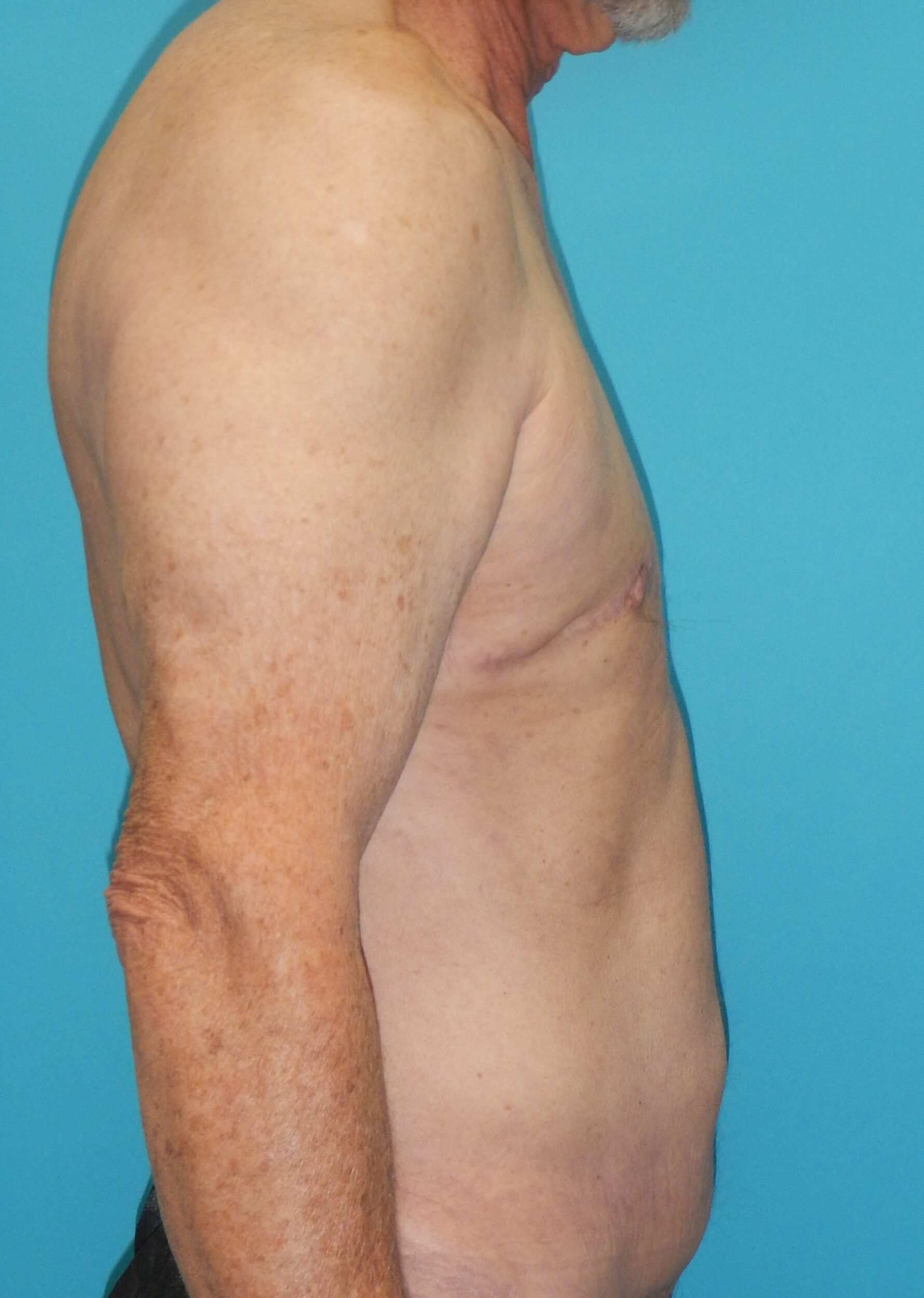 After Image: Gynecomastia: Case 5 - right-side