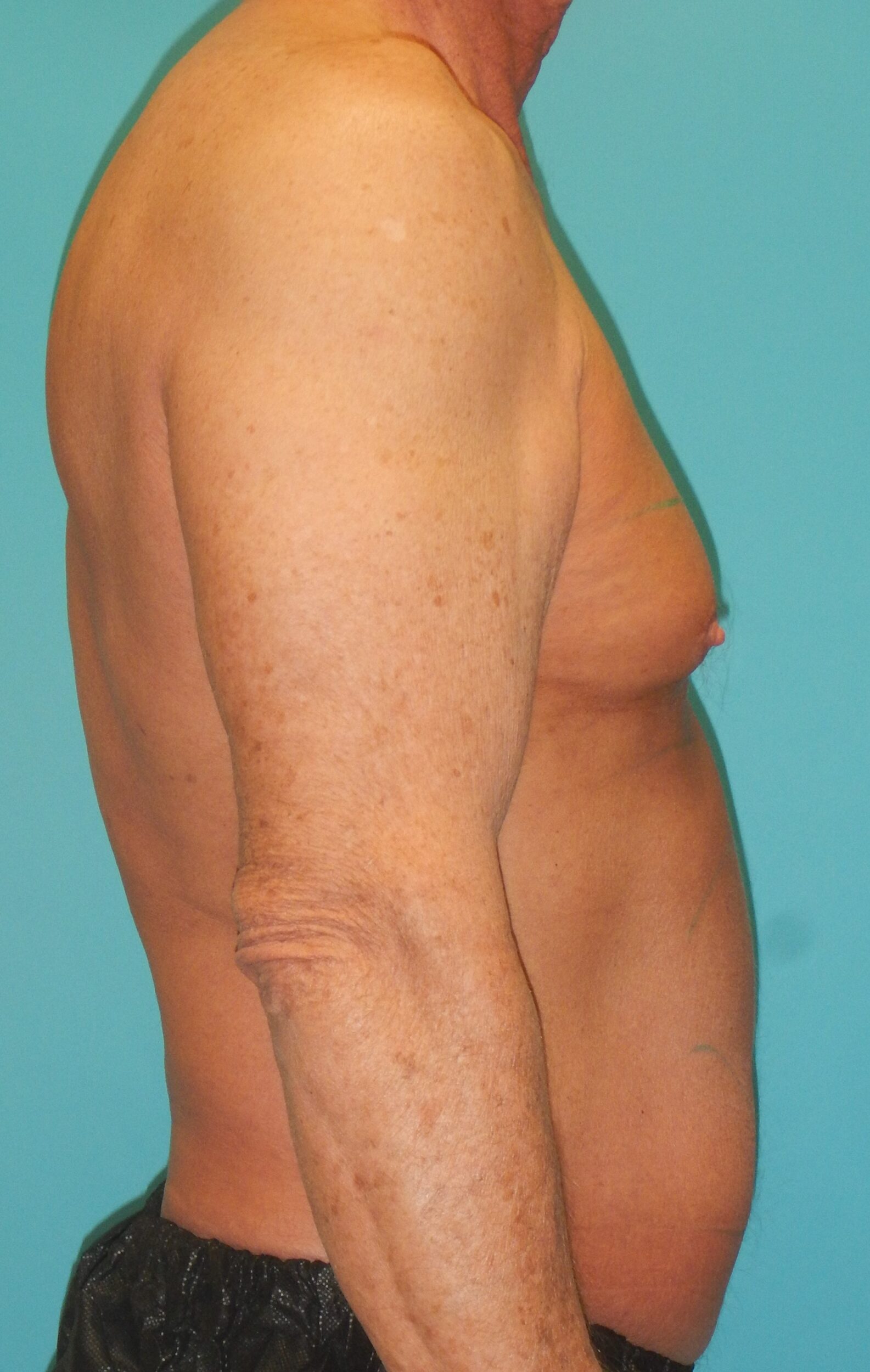 Before Image: Gynecomastia: Case 5 - right-side