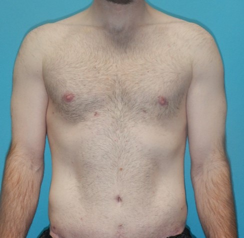 After Image: Gynecomastia: Case 6 - front