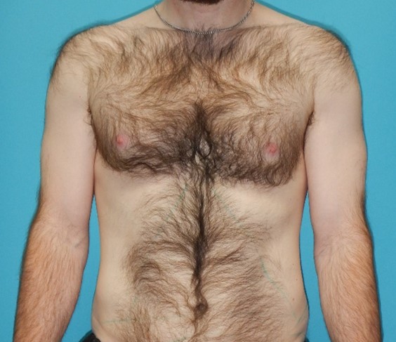Before Image: Gynecomastia: Case 6 - front