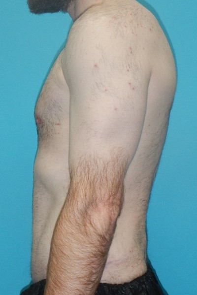 After Image: Gynecomastia: Case 6 - left-side