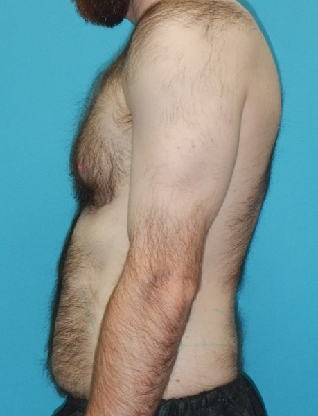 Before Image: Gynecomastia: Case 6 - left-side