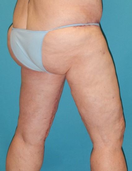 After Image: Inner Thigh Lift: Case 7 - right-back-oblique