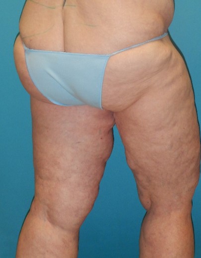 Before Image: Inner Thigh Lift: Case 7 - right-back-oblique