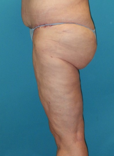 After Image: Inner Thigh Lift: Case 7 - left-side