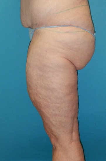 Before Image: Inner Thigh Lift: Case 7 - left-side