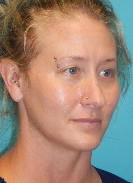 After Image: Laser Skin Resurfacing: Case 3 - right-front-oblique