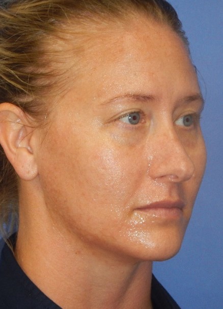 Before Image: Laser Skin Resurfacing: Case 3 - right-front-oblique