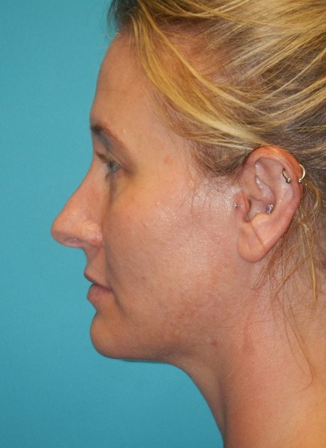 After Image: Laser Skin Resurfacing: Case 3 - left-side