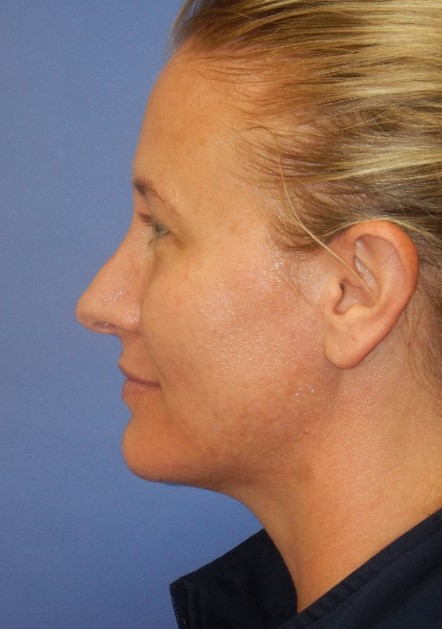 Before Image: Laser Skin Resurfacing: Case 3 - left-side
