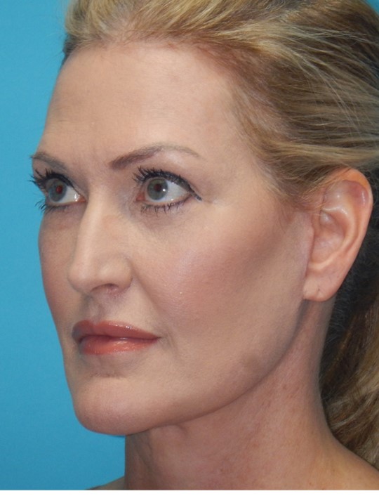 After Image: Mini Facelift: Case 12 - left-front-oblique