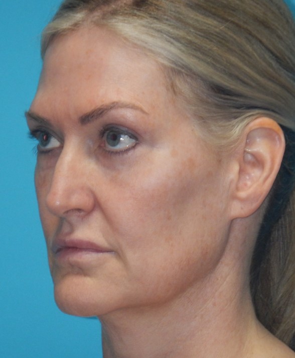 Before Image: Mini Facelift: Case 12 - left-front-oblique