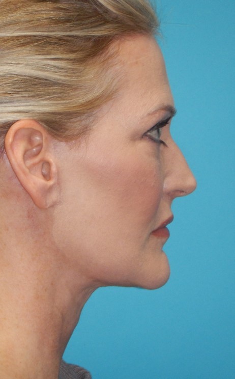 After Image: Mini Facelift: Case 12 - right-side