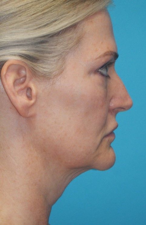 Before Image: Mini Facelift: Case 12 - right-side